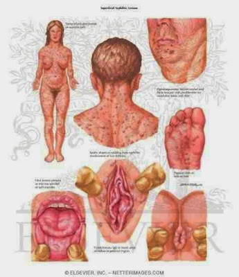 syphilis signs & symptoms