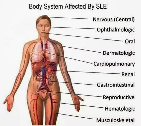 "Dunia Sihat Anda": SLE(Sytemic Lupus Erythematosus)