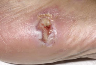 عندما تصرخ أقدامنا الشتاء!!!! princ_rm_photo_of_ulcer_on_foot.jpg