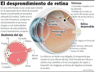 desprendimiento de retina