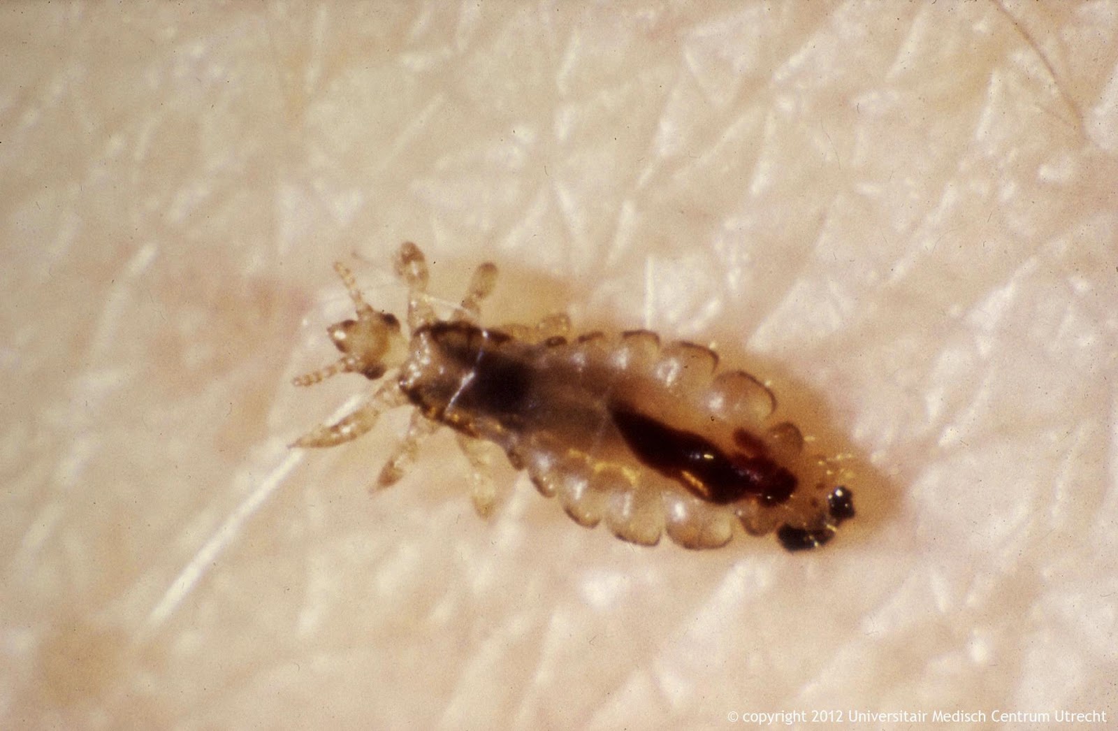 Head Lice Facts | Health And Beauty