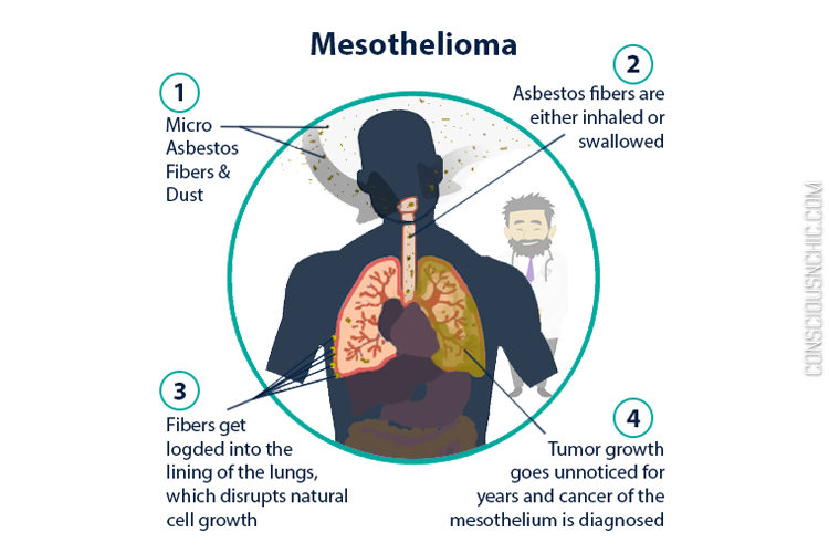 What are the signs and symptoms of mesothelioma?