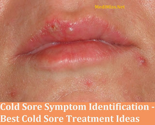 Cold Sore Symptom Identification - Best Cold Sore Treatment Ideas