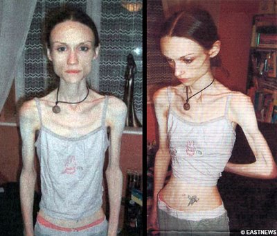 trending anorexic lady is too thin horribly deadly skinny