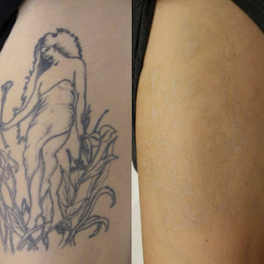 tattoo removal