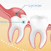 Điều trị viêm lợi trùm răng khôn