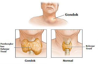 Gondongan Atau Parotitis (Mumps) 