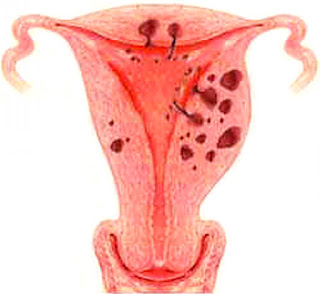  Uterine cancer is a malignant tumor inward the uterus What Is The Handling For Uterine Cancer?