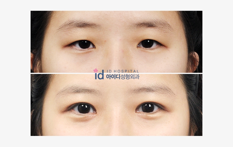 ID Hospital Korea: FAQ Eyelid Surgery! Everything you need t