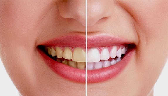Cara Cepat Memutihkan Gigi secara Alami