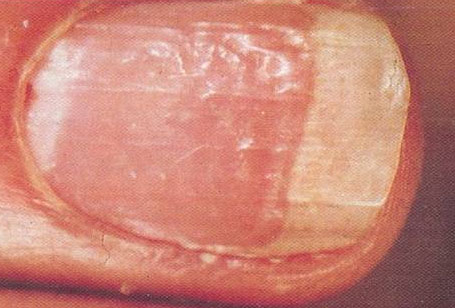 Scleroderma and Nail Pitting