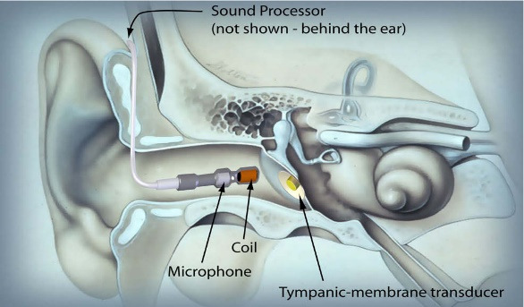 Earlens Corporation-Nonsurgical Hearing Solution Vibrating Eardrum Directly