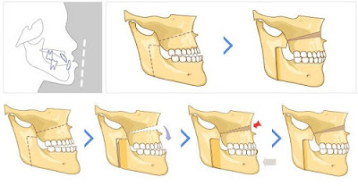 Hỏi bác sĩ phẫu thuật hàm móm có nguy hiểm không-1