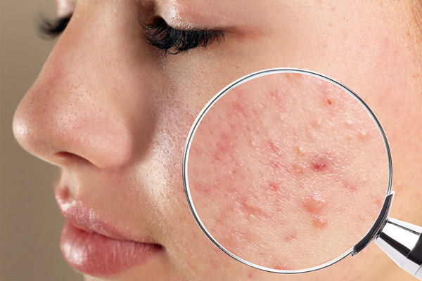 The Real Cause for Acne & Treatment