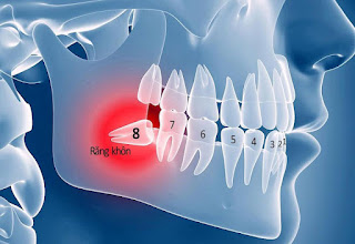 Răng khôn mọc trong bao lâu-2