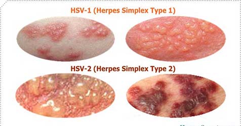 Herpes Causes, Symptoms, and Treatments • TheGep Diseases