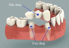  Trồng răng hàm có đau không?