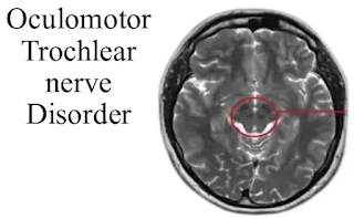 Oculomotor and Trochlear nerve