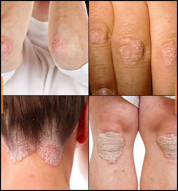 Psoriasis, skin problems, herbal remedies, psoriasis