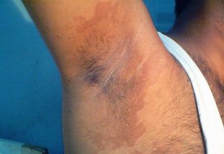 L'érythrasma est une infection cutanée fréquente à Corynebacterium minutissimum (bactérie saprophyte).  L'infection est localisée dans les plis (creux axillaire, creux inguinal, plis inter-fessier…) et consiste en une macule bien délimitée, de couleur rouge-brun avec de fines squames.