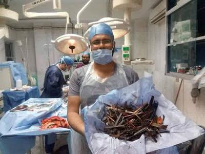 Psychic Disorder: Doctors Remove Nails, Spoon, Wood and Other Materials from a Woman’s Stomach