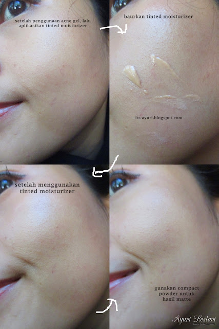 Mustika Puteri Acne Series Review