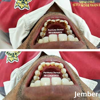 gambar foto sebelum dan sesudah scalling bersihkan karang gigi sisa rokok nikotin gigi kuning gigi kotor bekas kopi plak gigi noda gigi flek bercak pada gigi