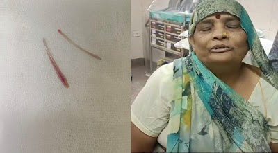 वृद्धा के पेट से निकाले 3 सेंटीमीटर लम्बे दो नुकीले मछली के कांटे