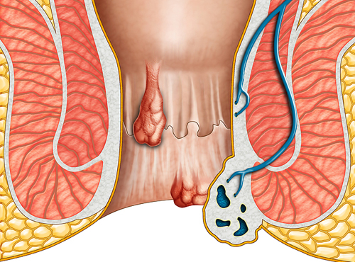 Mengobati Wasir Internal