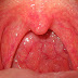 Sore Throat: Learn About Causes and Remedies