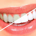 Phương pháp tẩy trắng răng tại nhà hiệu quả