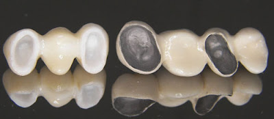 Độ bền của răng sứ thẩm mỹ 