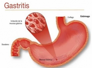 Penyebab  Dan Cara Mengobati Gastritis  Akut Pharmacy Care