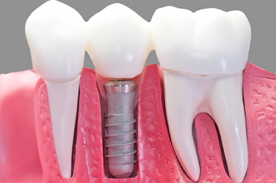 Cấy ghép răng implant ở đâu tốt nhất hiện nay? 2