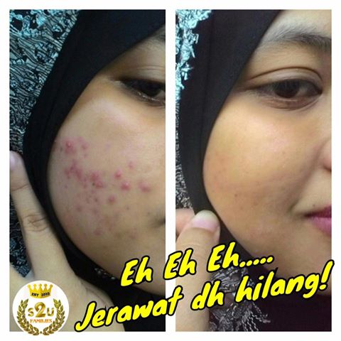 Jerawat Naik Semasa Hamil | Testimoni Set Hamil Shaklee