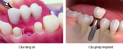 Mất răng nên làm cầu răng hay implant?