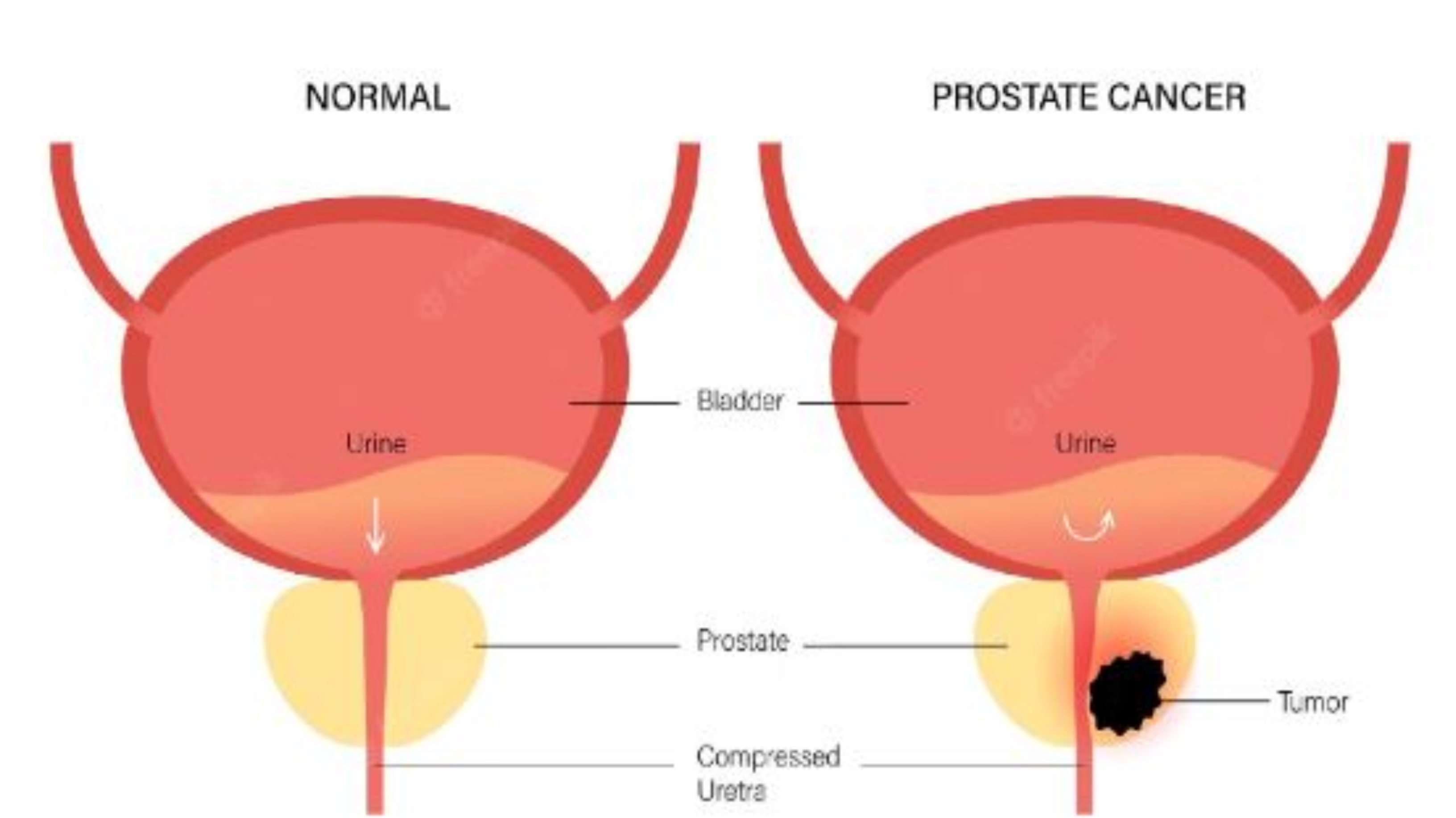 https://www.healthandfitnessexpert.in/2024/05/what-is-prostate-cancer.html