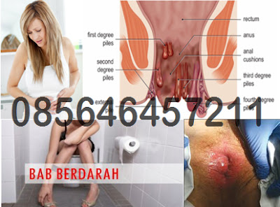 Harga Obat Wasir Internal di Toko Online