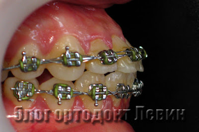 Зубы отклонены вперед у пациента с потерей анкоража
