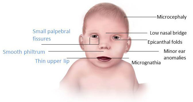 Odkrywajac Psychologie Fas Fetal Alcohol Syndrome Czyli Alkoholowy Zespol Plodowy