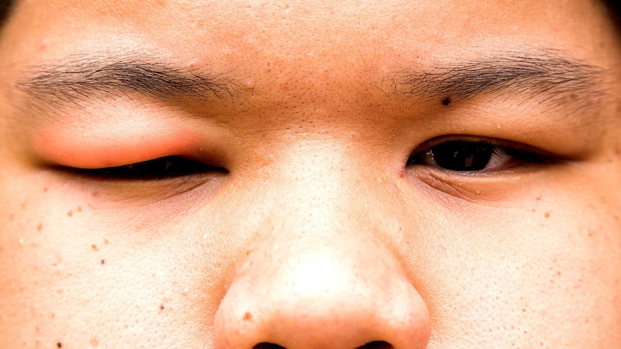 Allergy Eyes Swollen