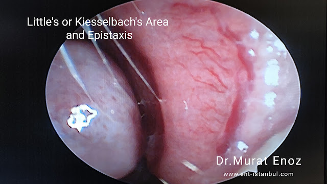Little's or Kiesselbach's Area and Epistaxis
