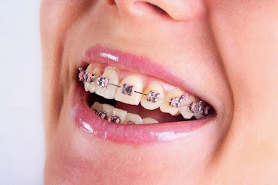 Răng hàm bị mất có niềng răng được không? 