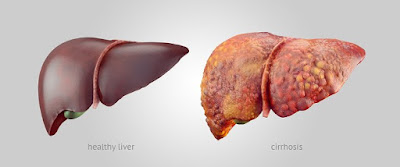 Obat Liver Yang Paling Mujarab