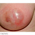 Breast Abscess: Causes, Symptoms, Diagnosis, and Treatment Options