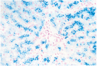 Hereditary hemochromatosis