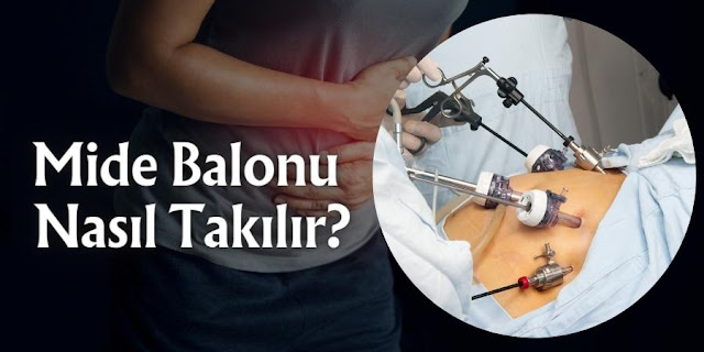 Mide Balonu Nasıl Takılır?