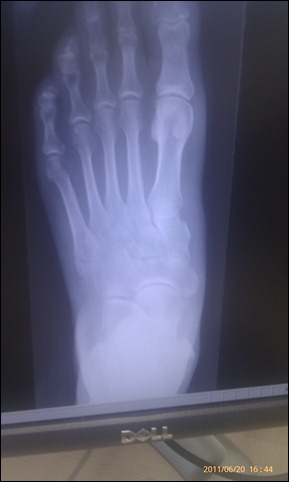 Left Foot 20jun2011 Showing non-healing of 5th Metatarsal