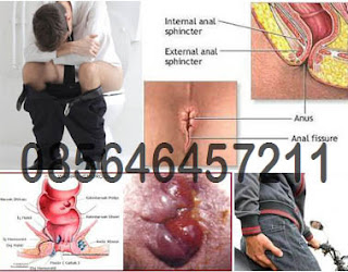 Apakah Penyakit Wasir Luar Bisa Sembuh Total