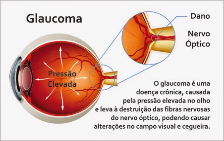 Conheça os hábitos que podem agravar o glaucoma